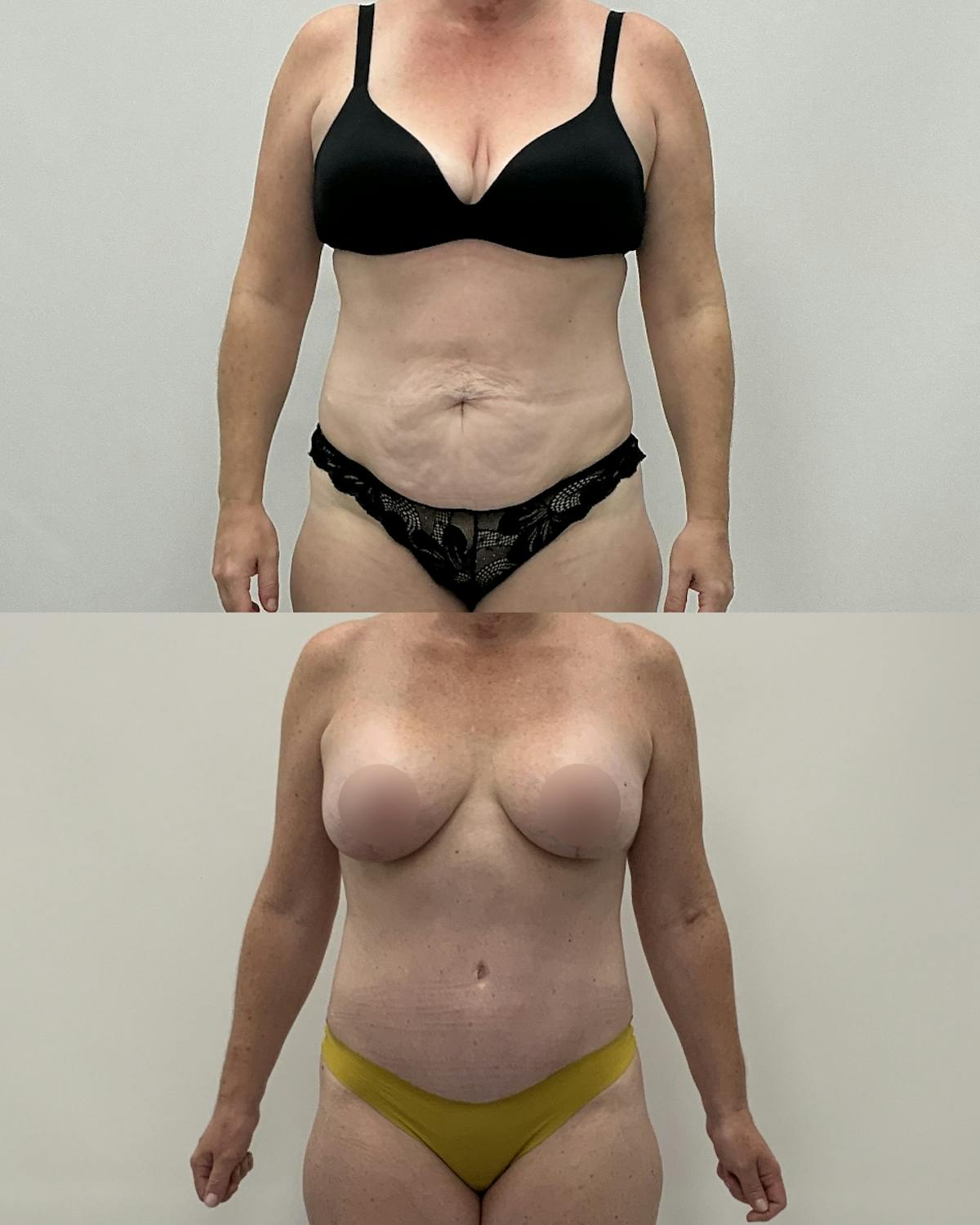 Mommy Makeover Before & After Gallery - Patient 383866 - Image 1