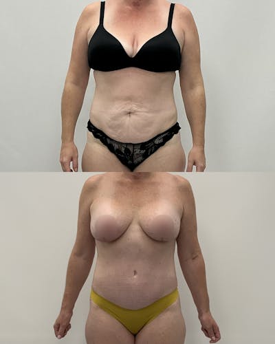 Mommy Makeover Before & After Gallery - Patient 383866 - Image 1