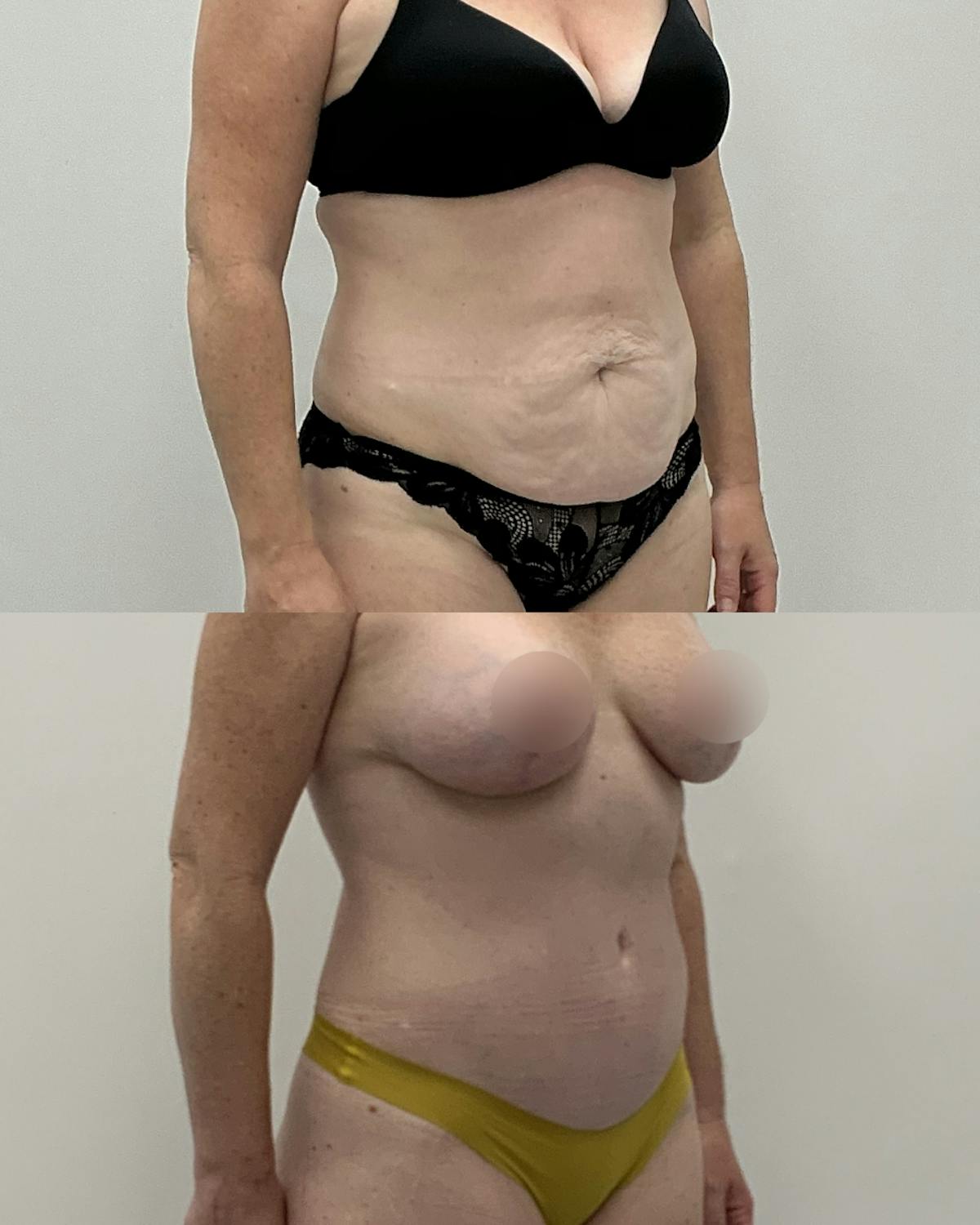 Tummy Tuck Before & After Gallery - Patient 272787 - Image 2