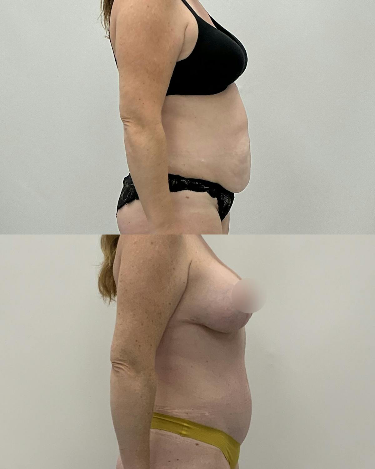 Tummy Tuck Before & After Gallery - Patient 272787 - Image 3