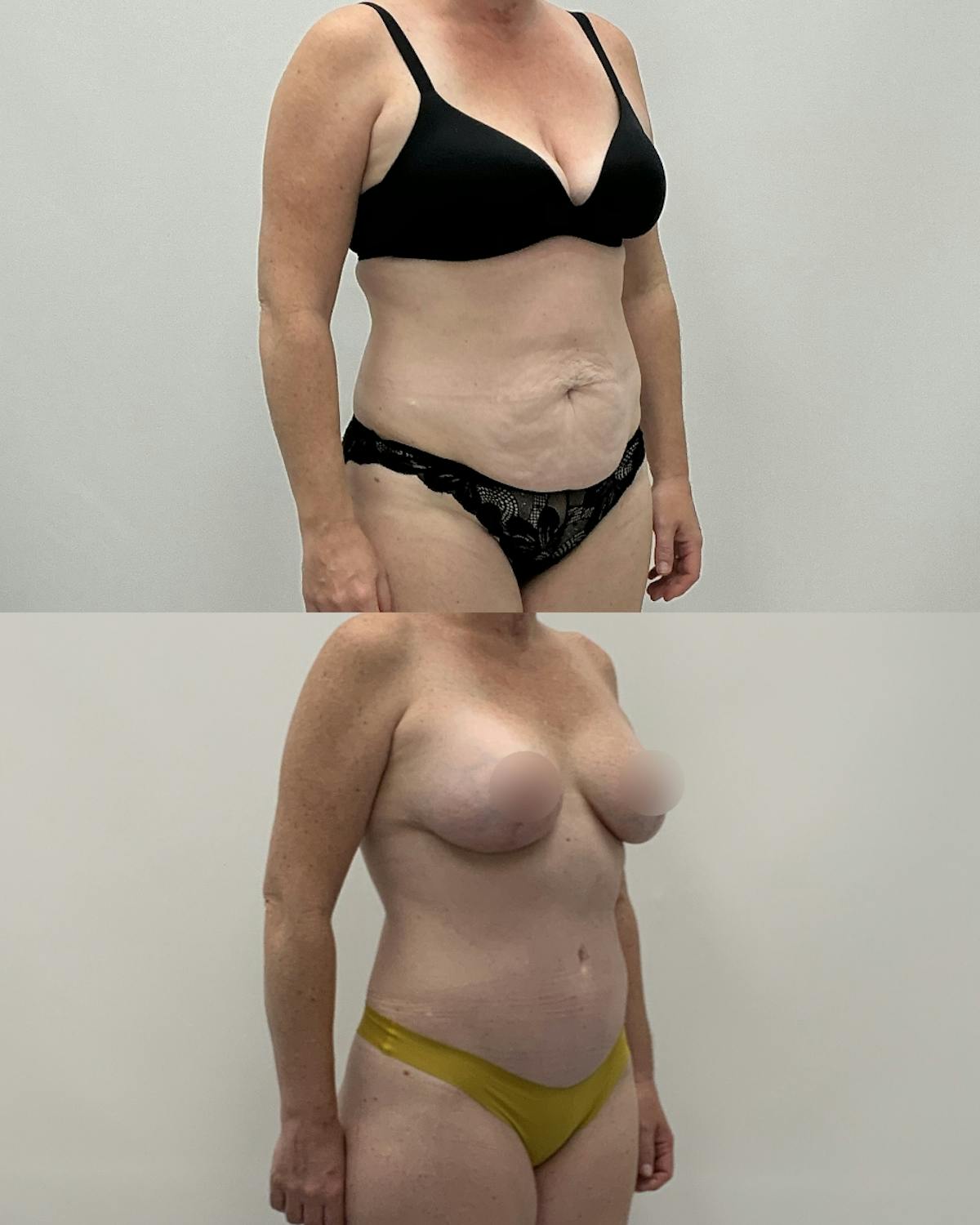 Mommy Makeover Before & After Gallery - Patient 383866 - Image 2