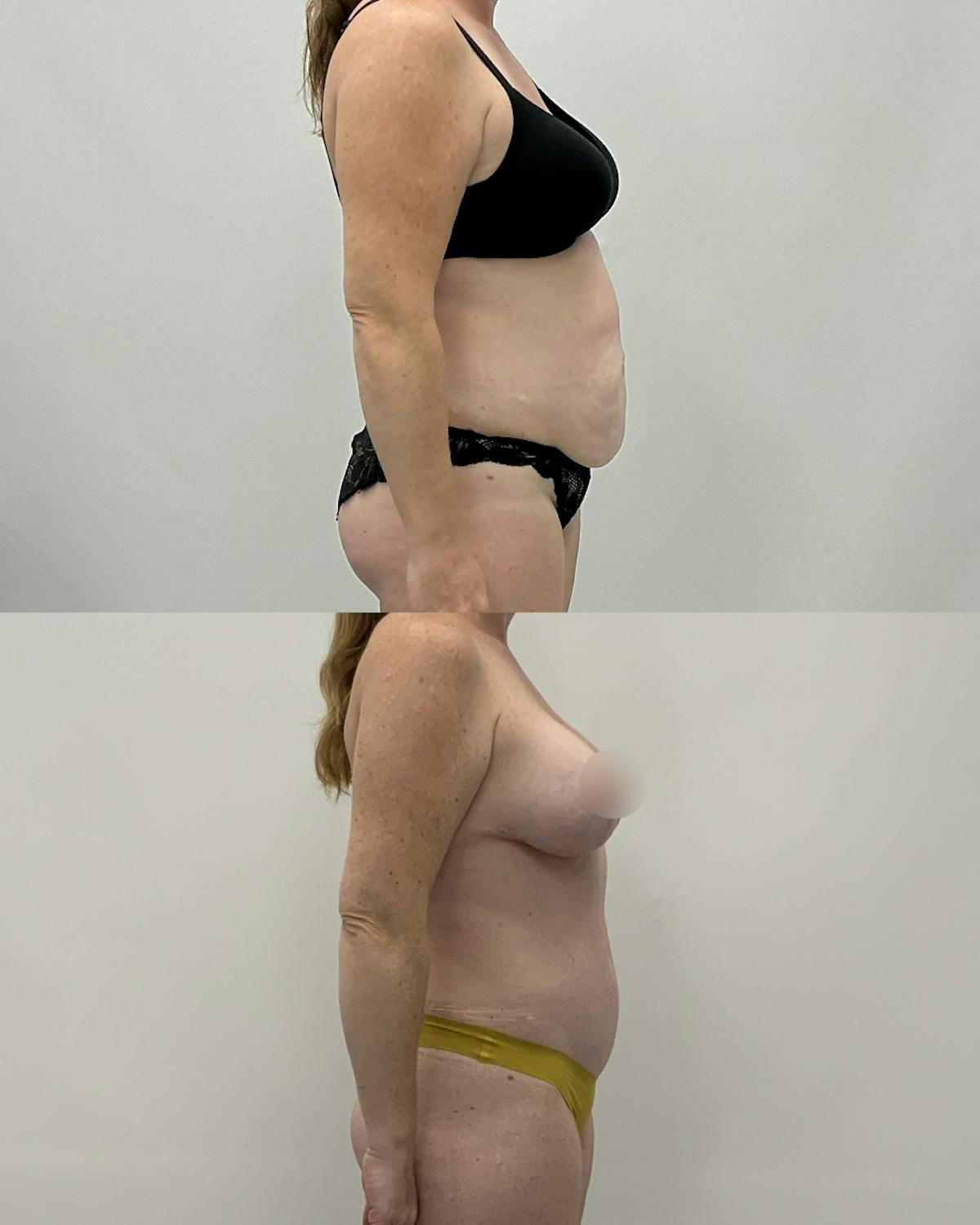 Mommy Makeover Before & After Gallery - Patient 383866 - Image 3
