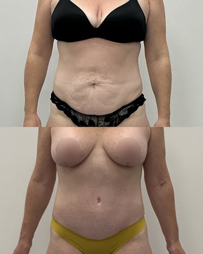 Tummy Tuck Before & After Gallery - Patient 272787 - Image 1
