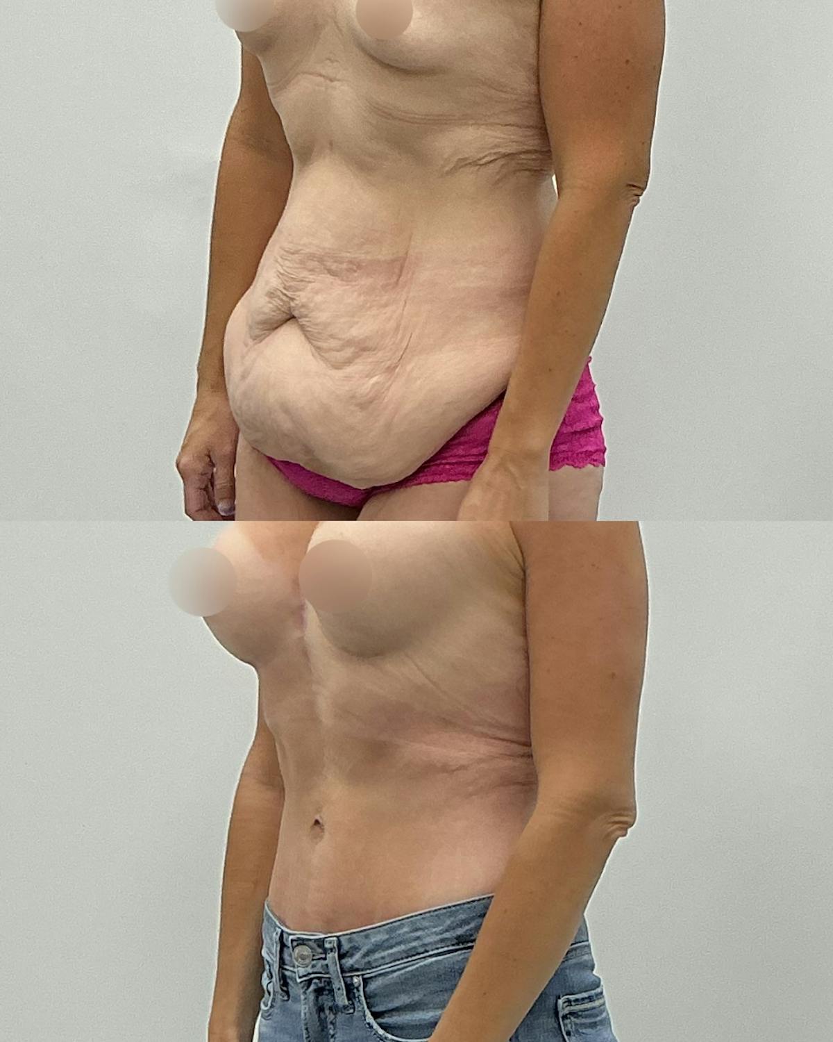 Tummy Tuck Before & After Gallery - Patient 273247 - Image 2