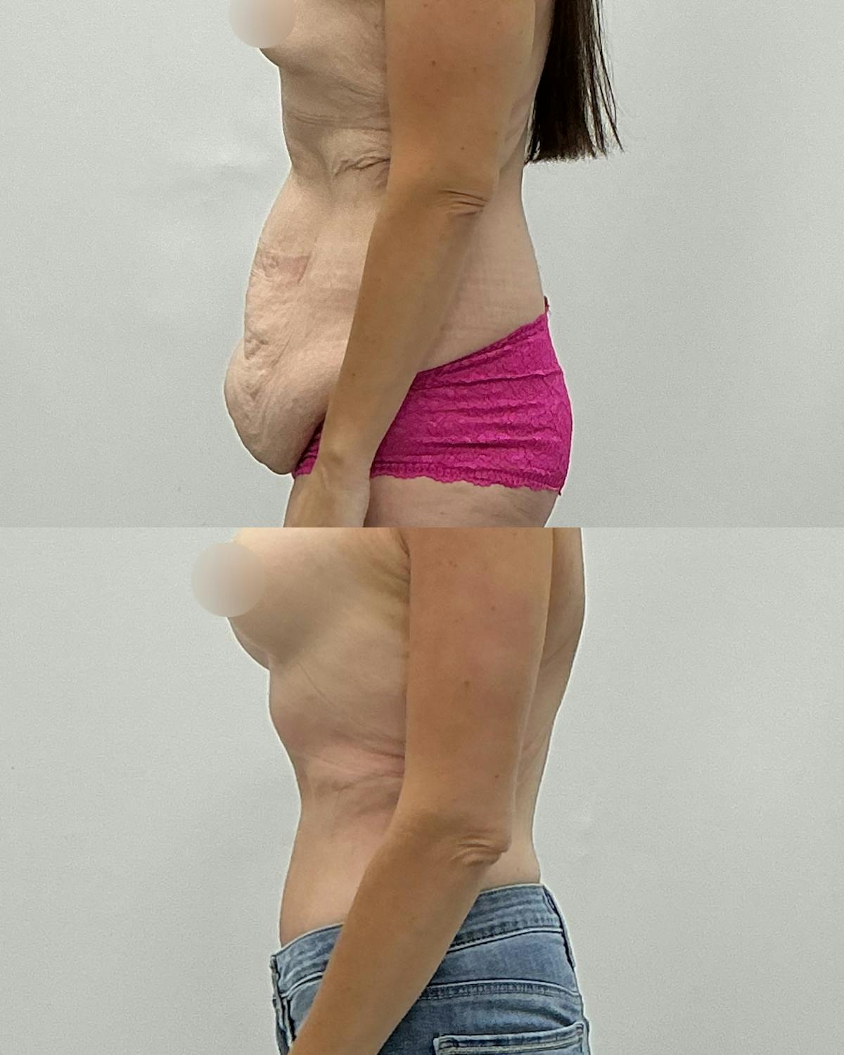 Tummy Tuck Before & After Gallery - Patient 273247 - Image 3