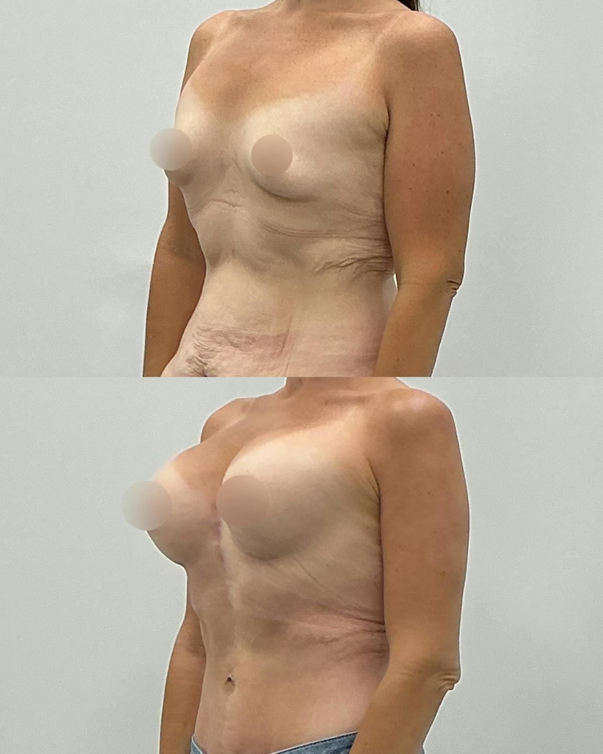 Breast Augmentation Before & After Gallery - Patient 193305 - Image 2