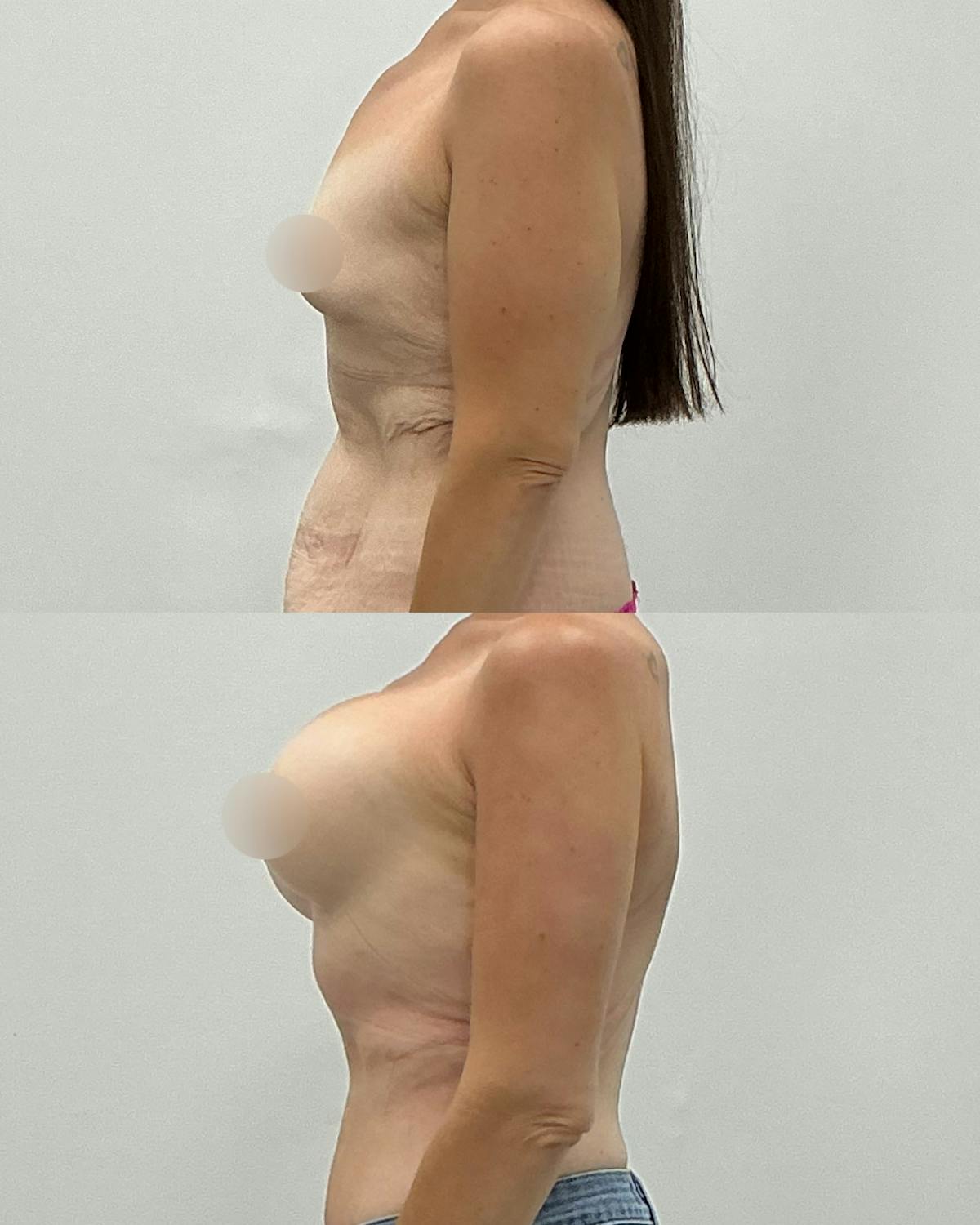 Breast Augmentation Before & After Gallery - Patient 193305 - Image 3