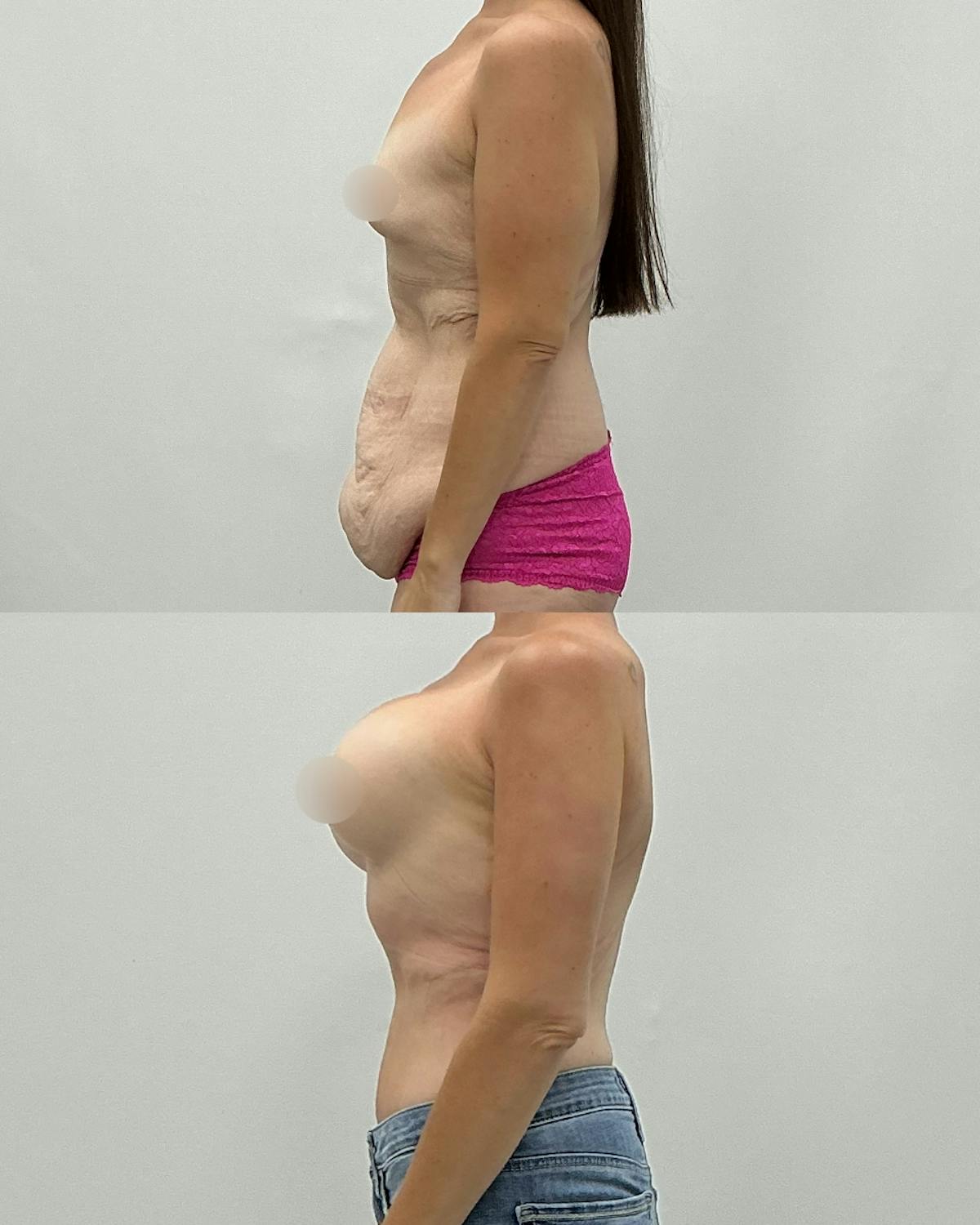 Mommy Makeover Before & After Gallery - Patient 170119 - Image 3