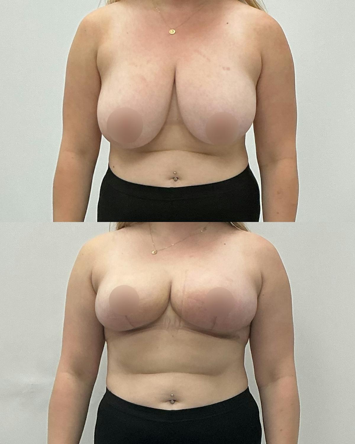 Breast Reduction Before & After Gallery - Patient 124505 - Image 1
