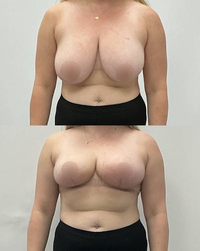 Breast Lift Before & After Gallery - Patient 206961 - Image 1