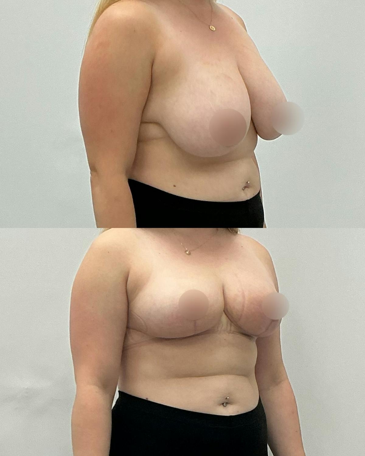 Breast Reduction Before & After Gallery - Patient 124505 - Image 2