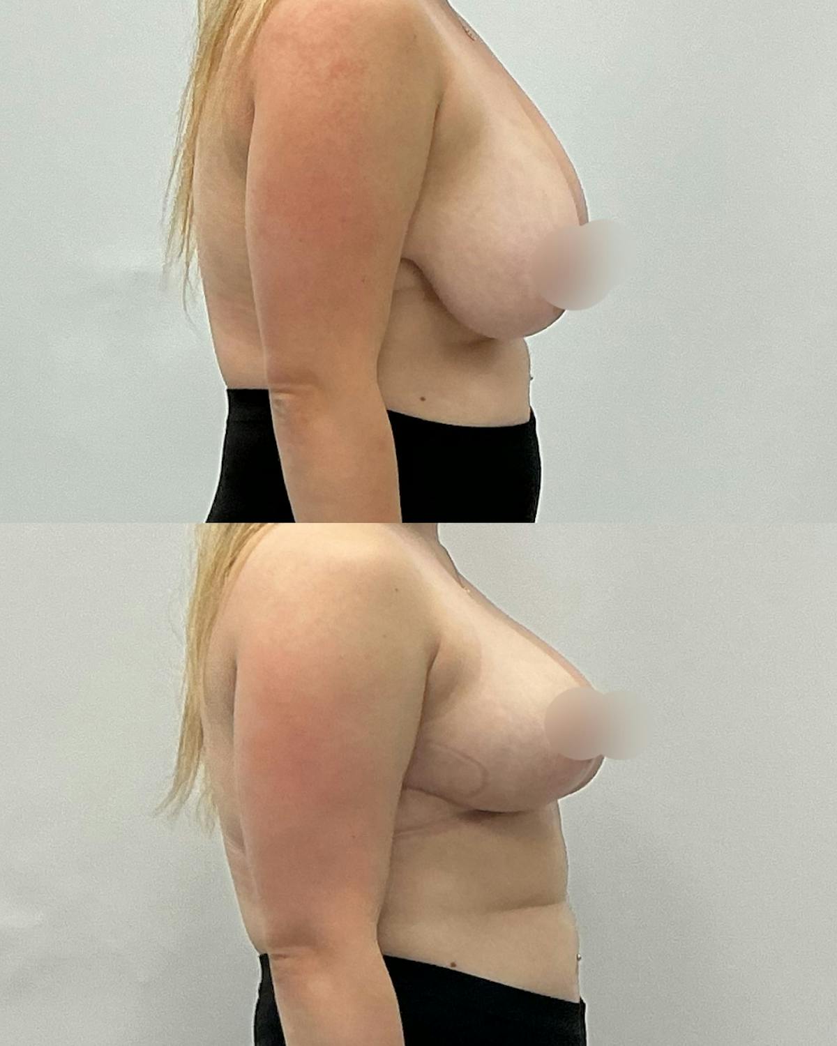 Breast Reduction Before & After Gallery - Patient 124505 - Image 3