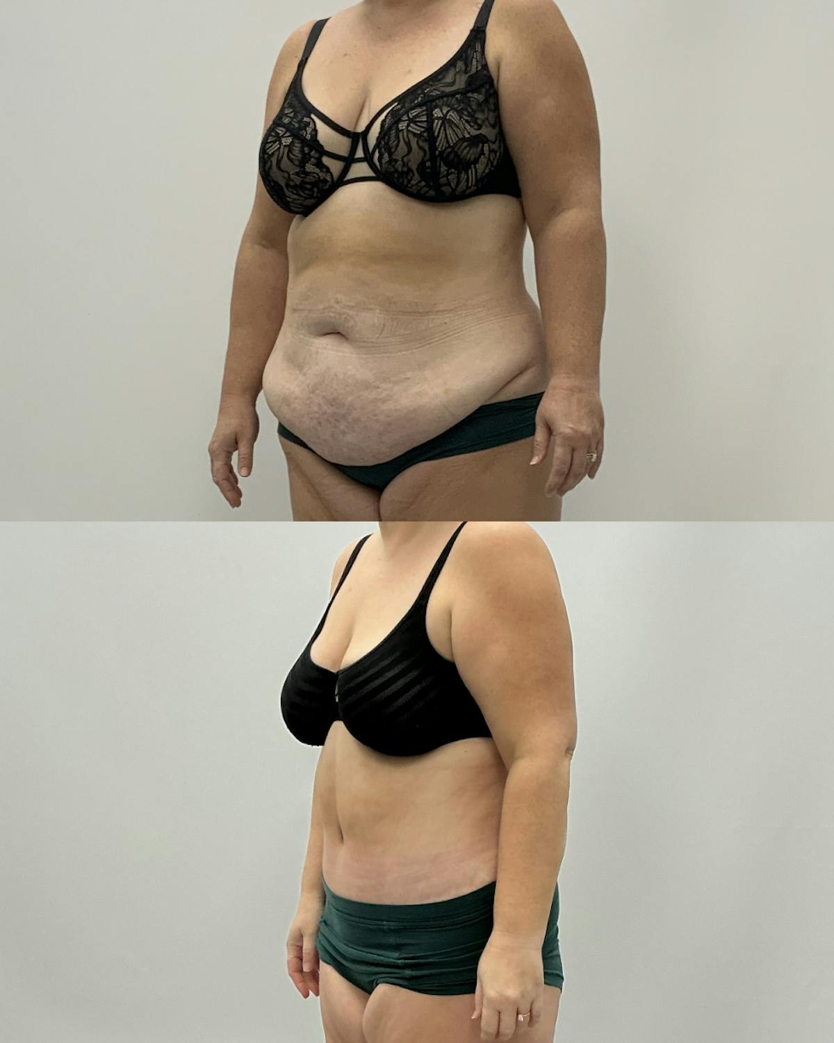 Tummy Tuck Before & After Gallery - Patient 122462 - Image 2