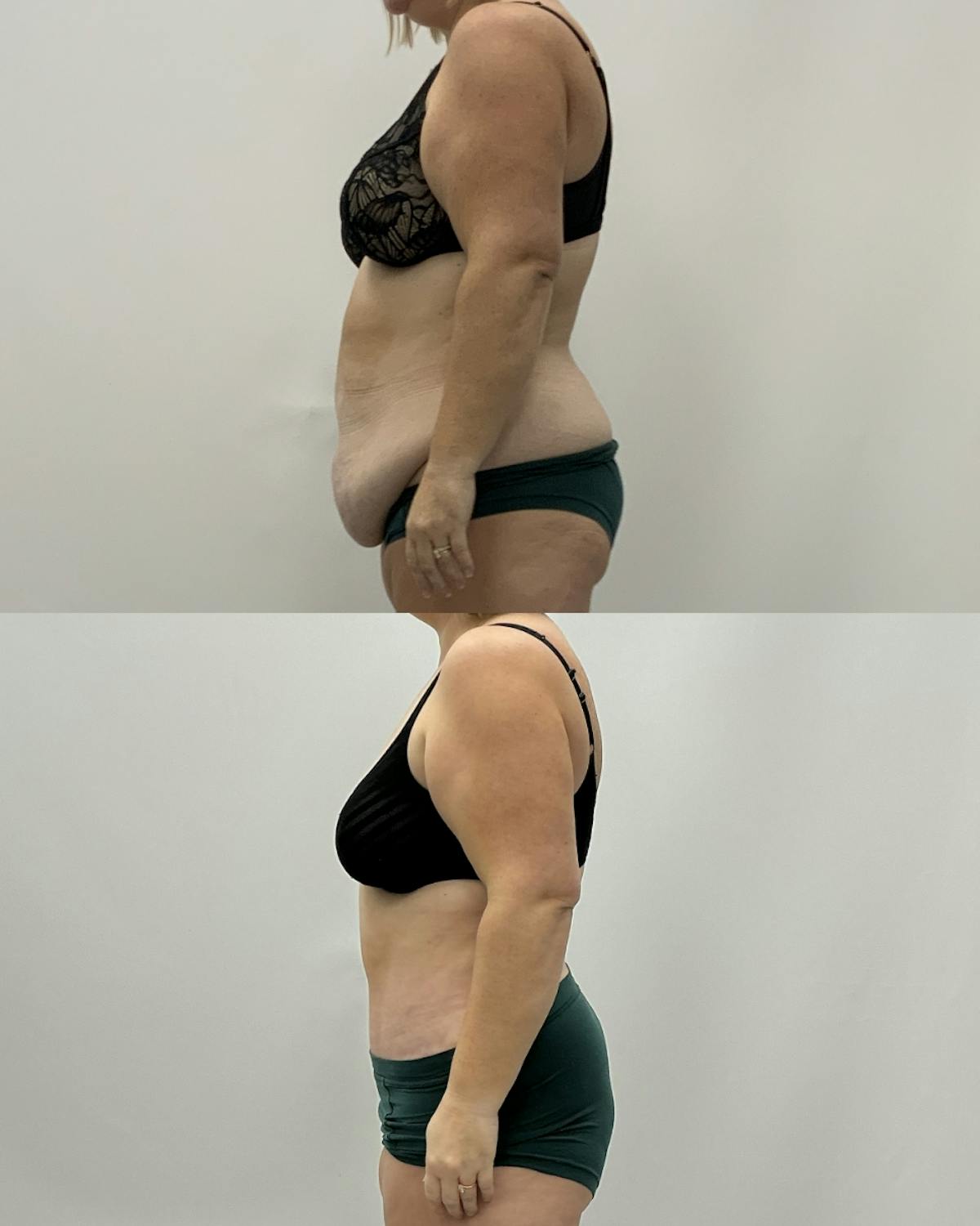 Tummy Tuck Before & After Gallery - Patient 122462 - Image 3