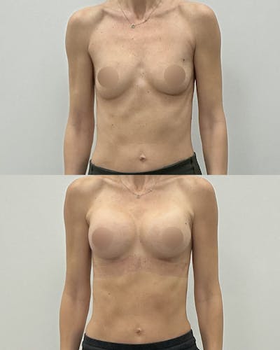 Breast Augmentation Before & After Gallery - Patient 175588 - Image 1