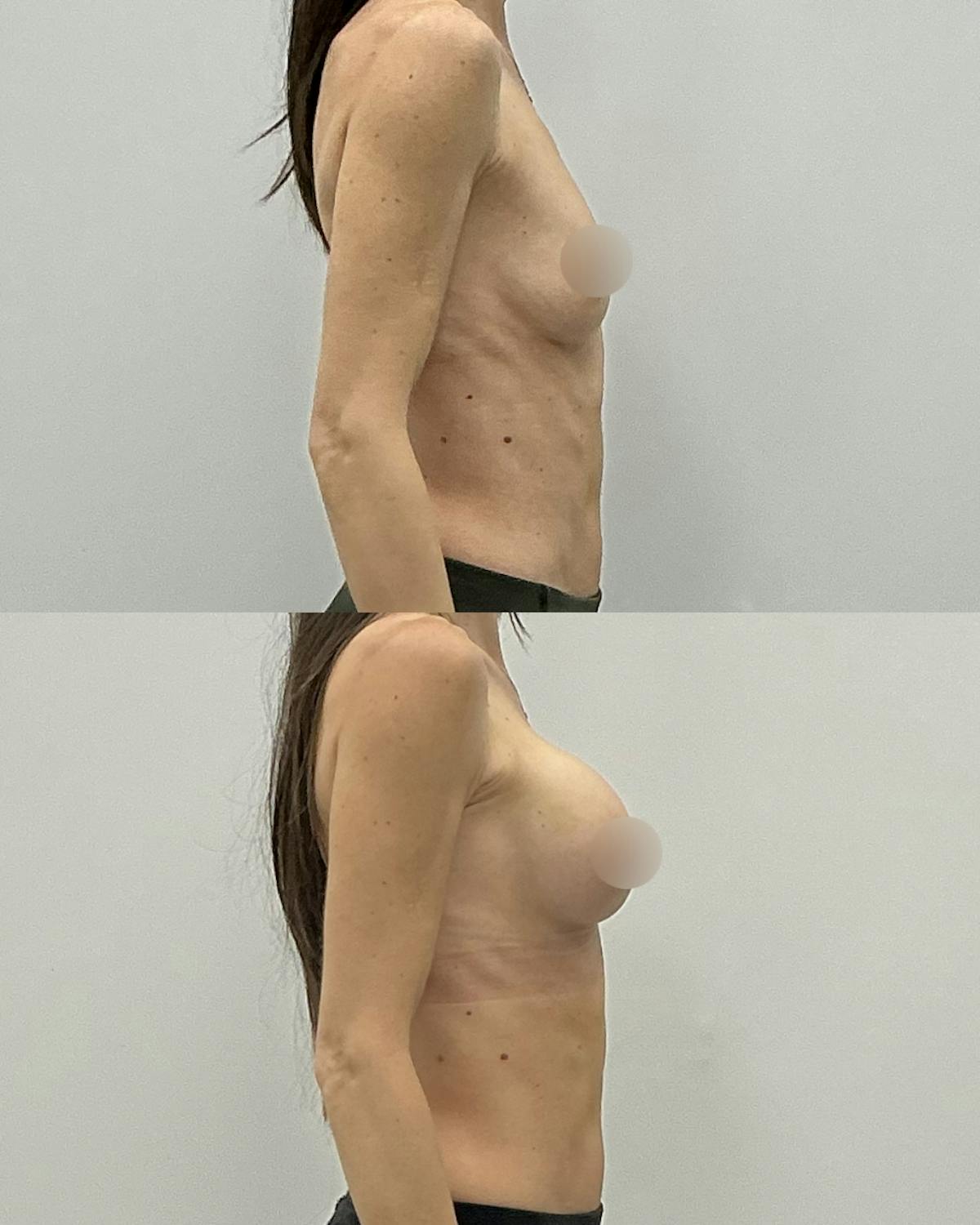 Breast Augmentation Before & After Gallery - Patient 175588 - Image 3