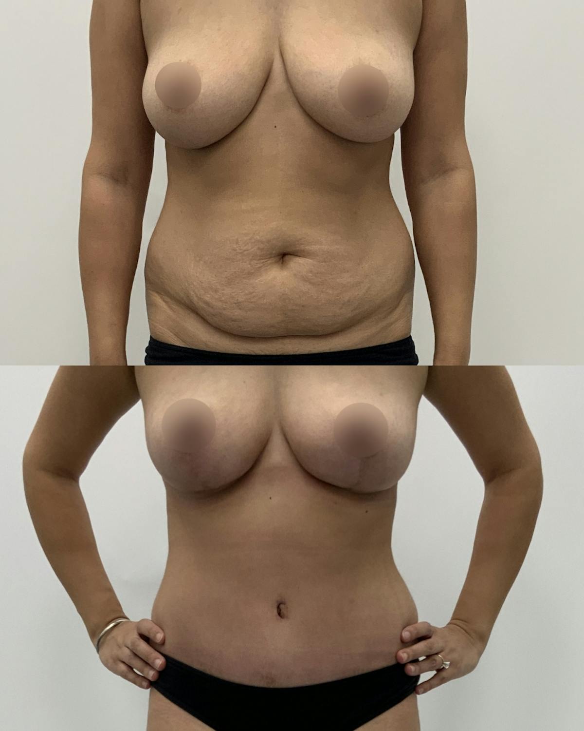 Tummy Tuck Before & After Gallery - Patient 102791 - Image 1