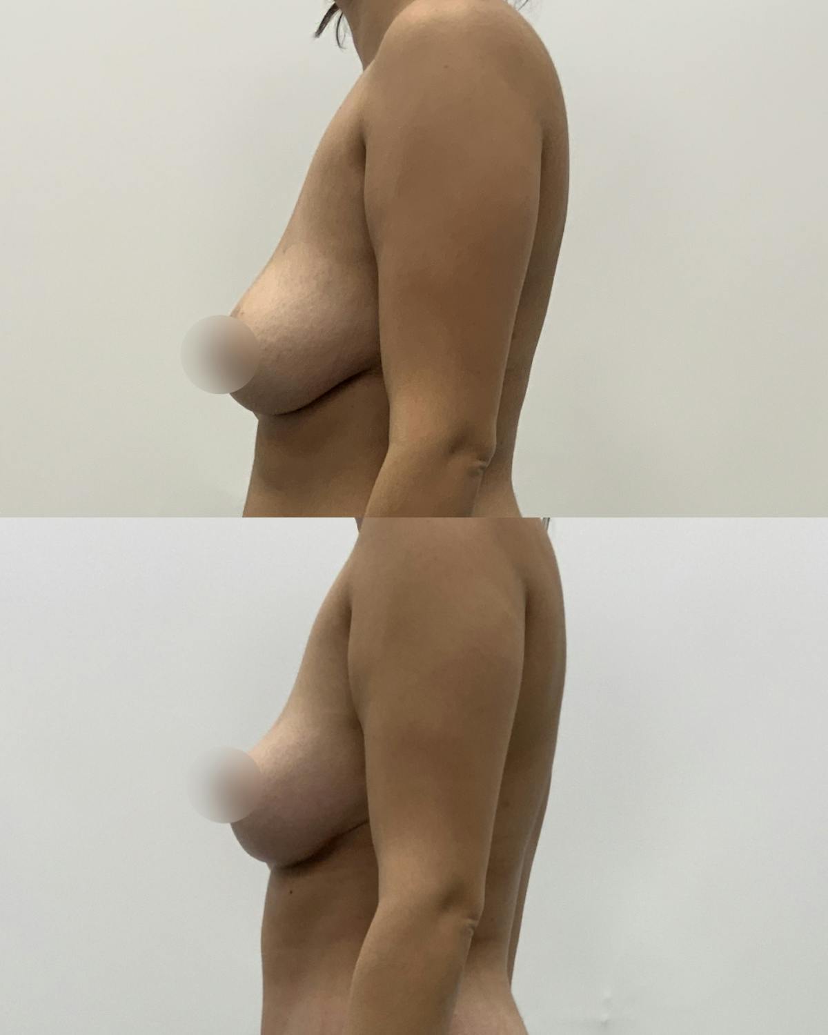 Breast Lift Before & After Gallery - Patient 236759 - Image 3