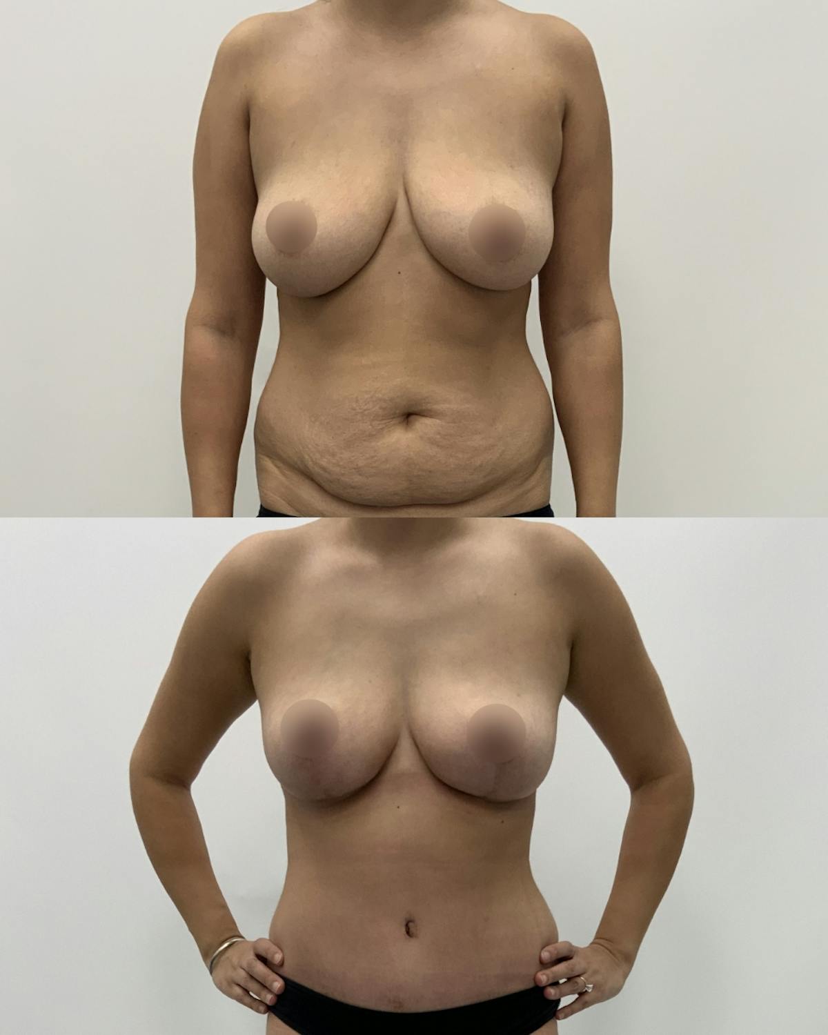 Mommy Makeover Before & After Gallery - Patient 403958 - Image 1