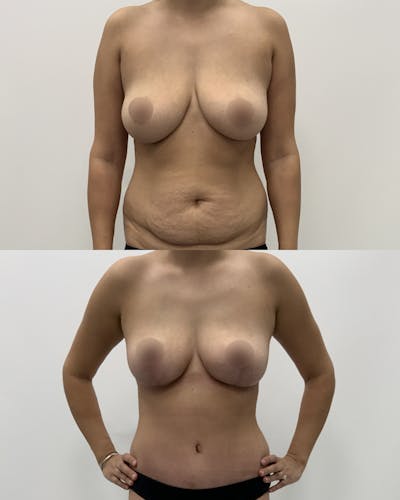 Mommy Makeover Before & After Gallery - Patient 403958 - Image 1