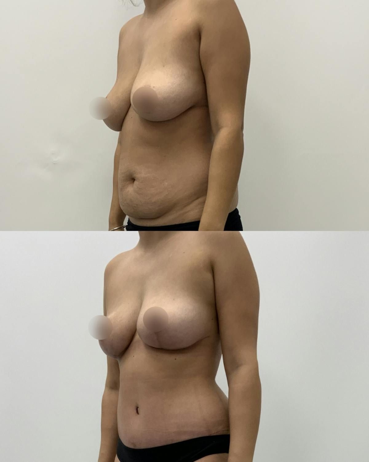Mommy Makeover Before & After Gallery - Patient 403958 - Image 2