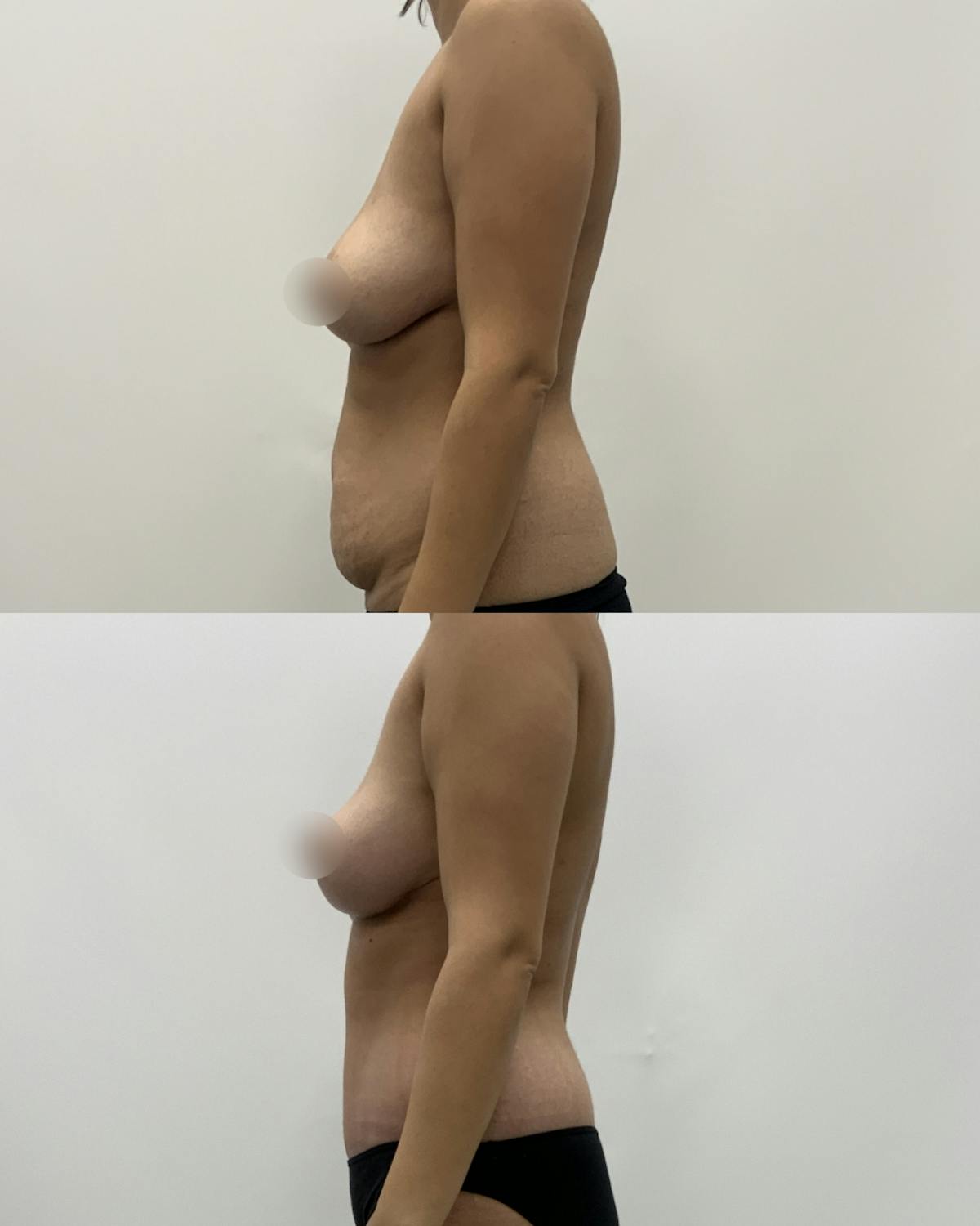 Mommy Makeover Before & After Gallery - Patient 403958 - Image 3