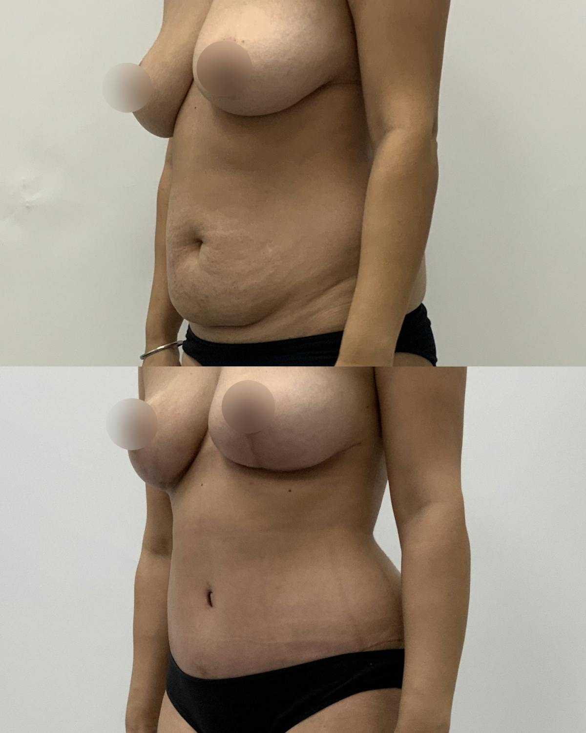 Tummy Tuck Before & After Gallery - Patient 102791 - Image 2