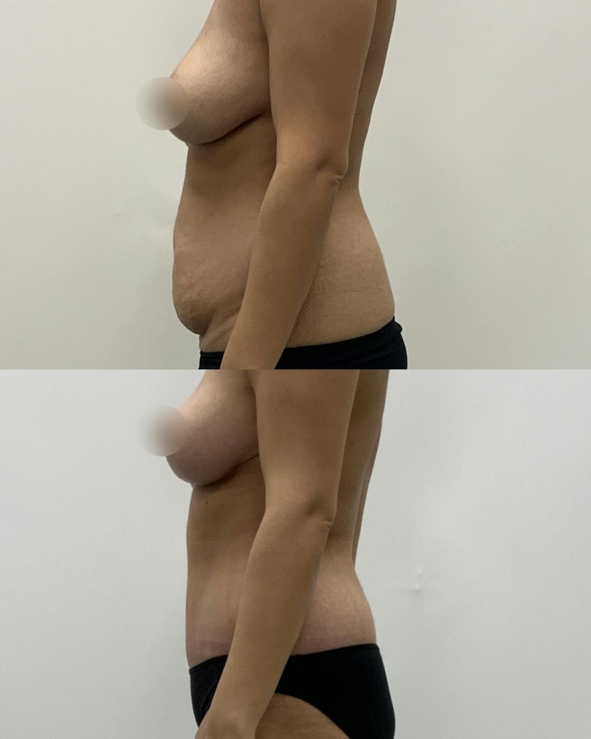 Tummy Tuck Before & After Gallery - Patient 102791 - Image 3