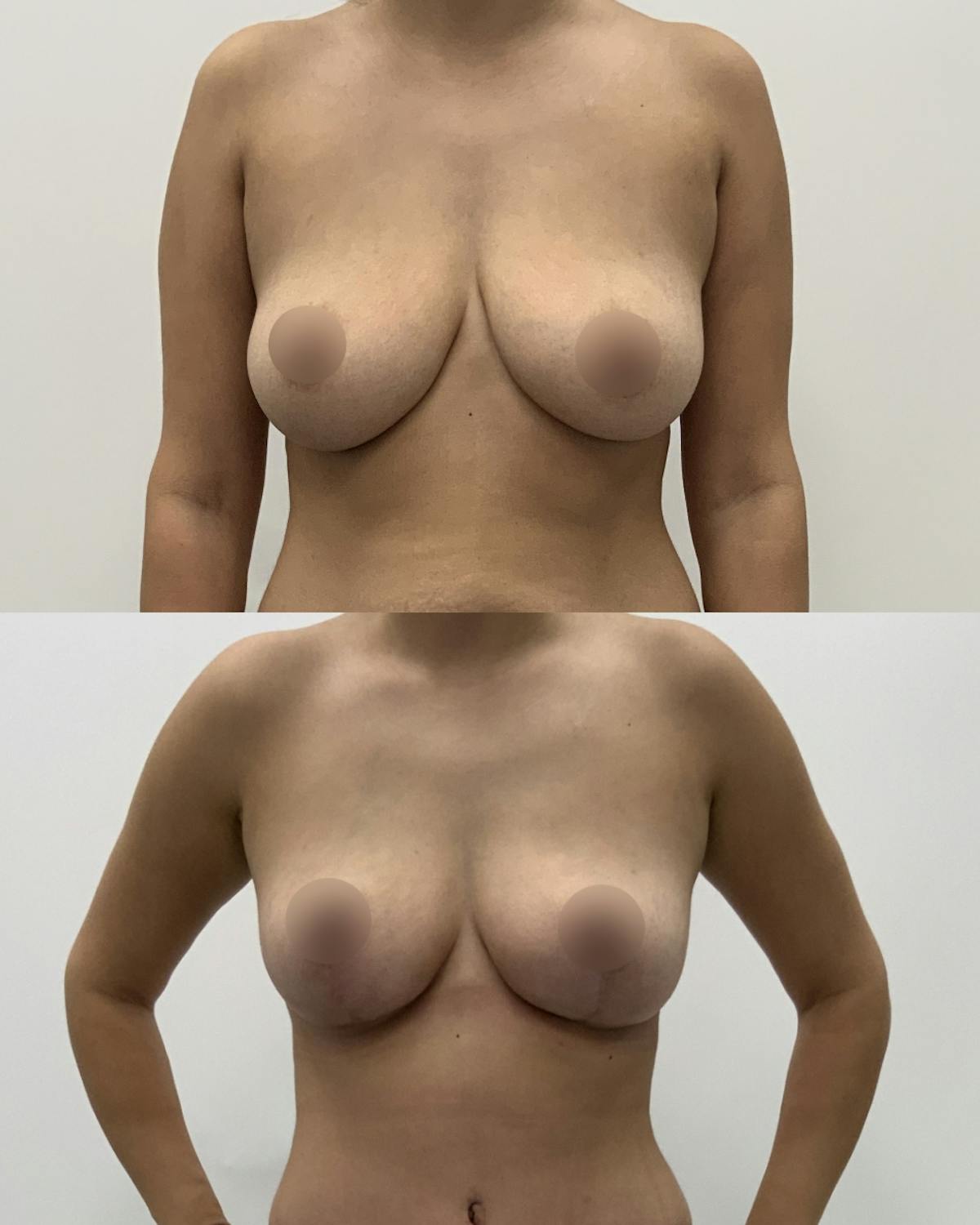 Breast Lift Before & After Gallery - Patient 236759 - Image 1