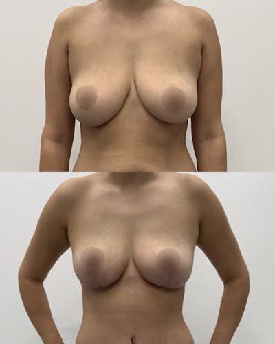 Breast Lift Before & After Gallery - Patient 236759 - Image 1