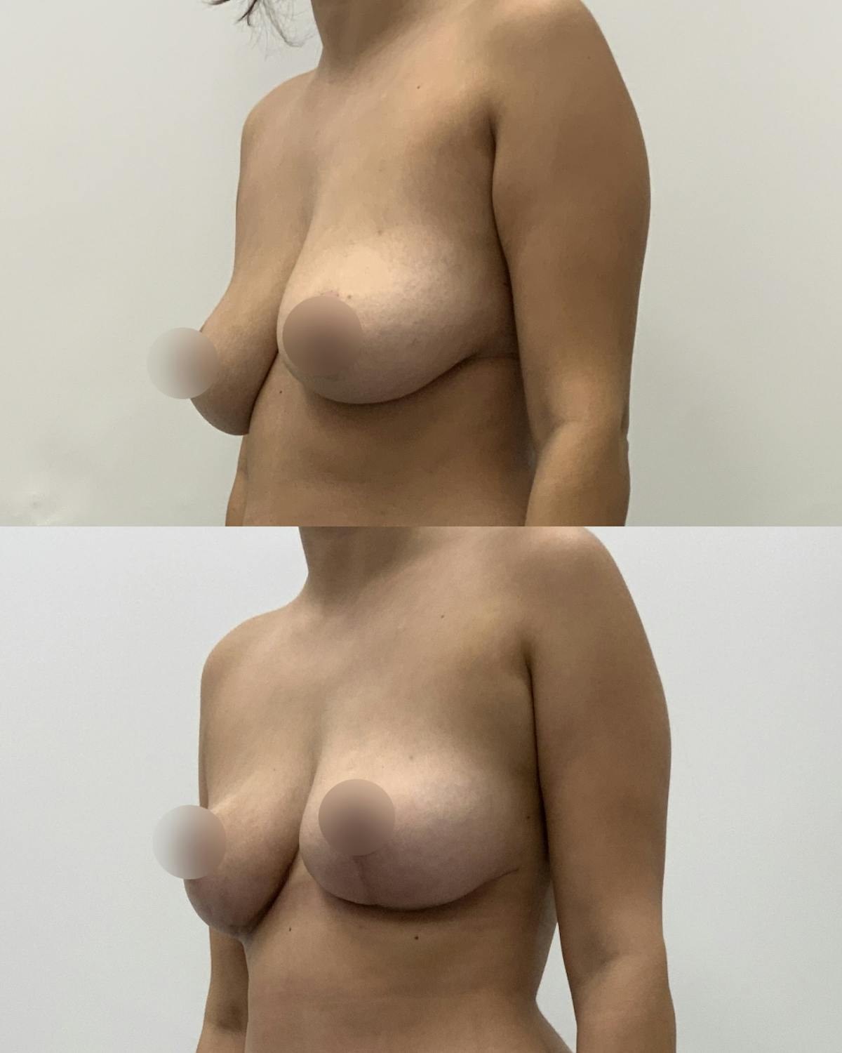 Breast Lift Before & After Gallery - Patient 236759 - Image 2