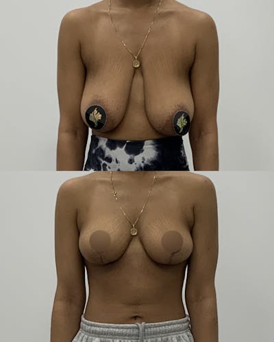 Breast Lift Before & After Gallery - Patient 230488 - Image 1