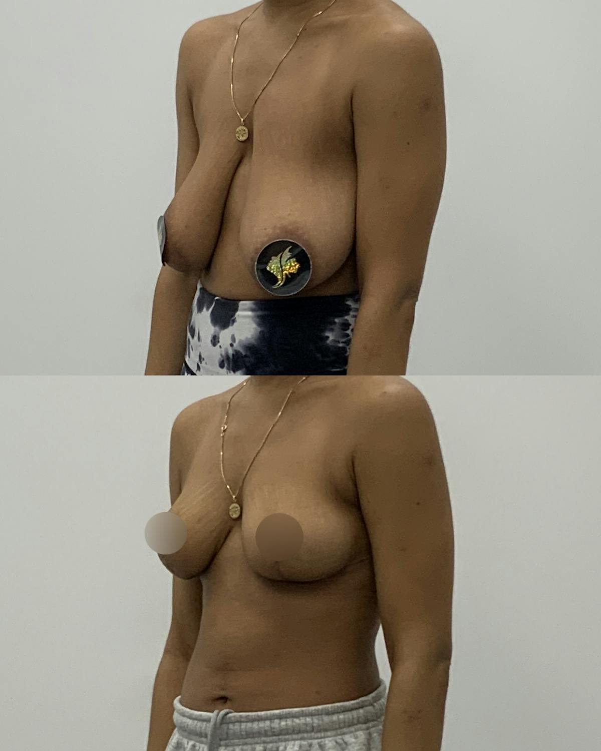 Breast Lift Before & After Gallery - Patient 230488 - Image 2