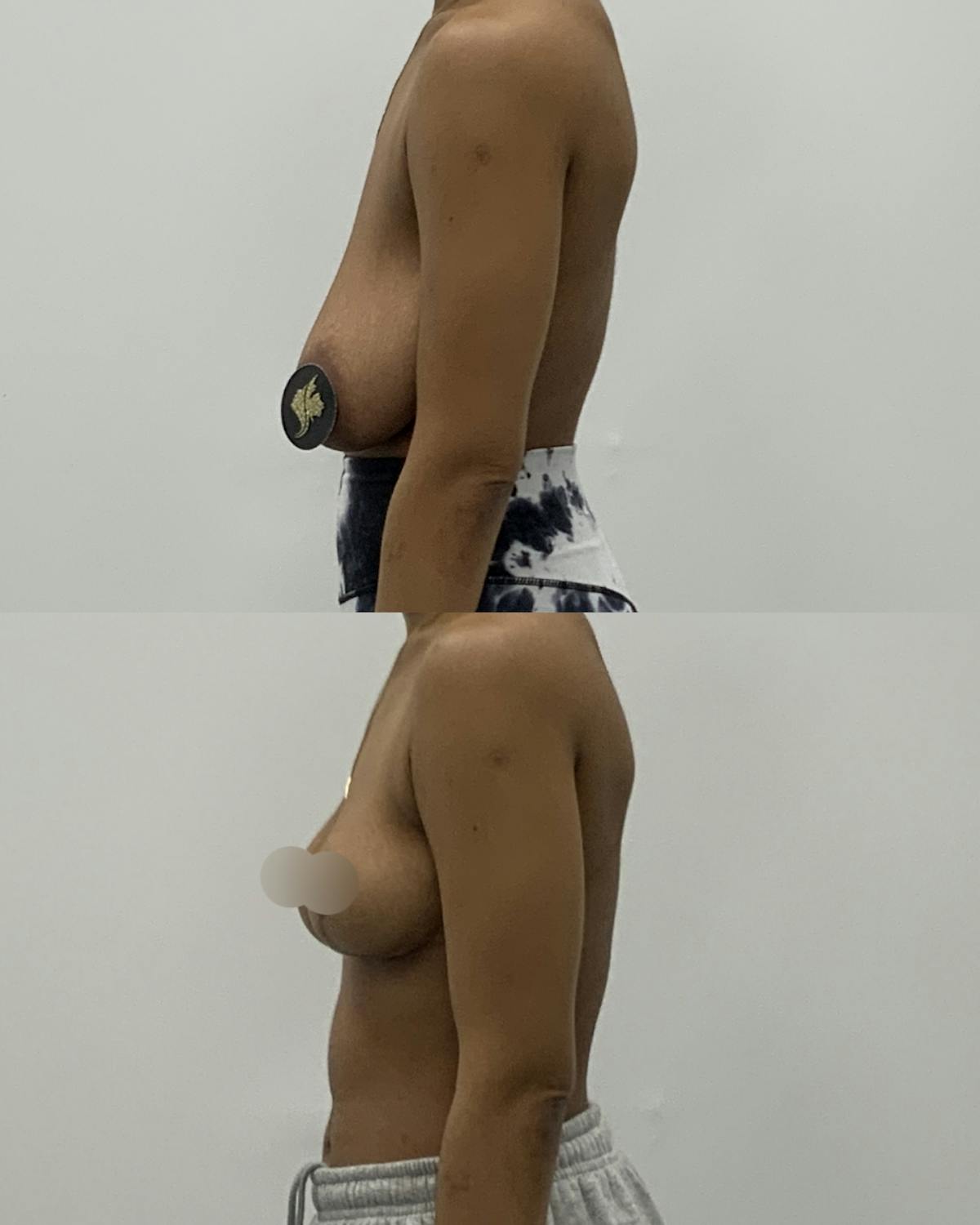 Breast Lift Before & After Gallery - Patient 230488 - Image 3