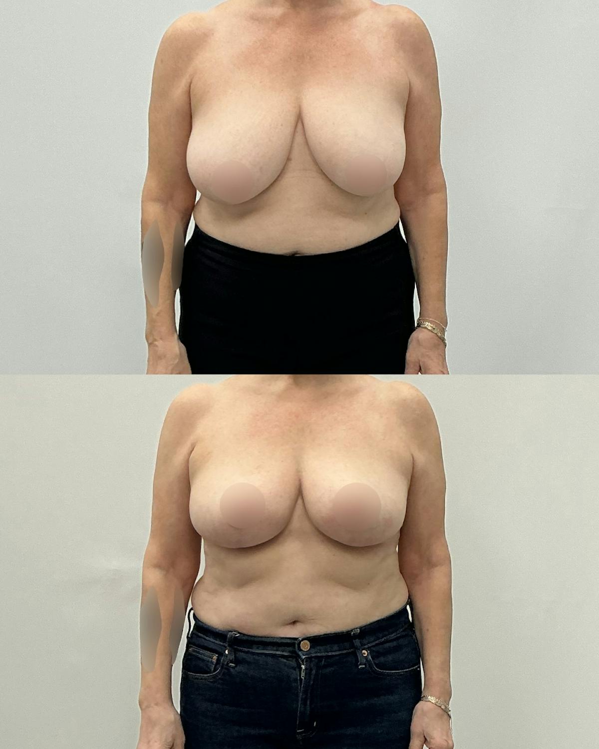 Breast Lift Before & After Gallery - Patient 384287 - Image 1
