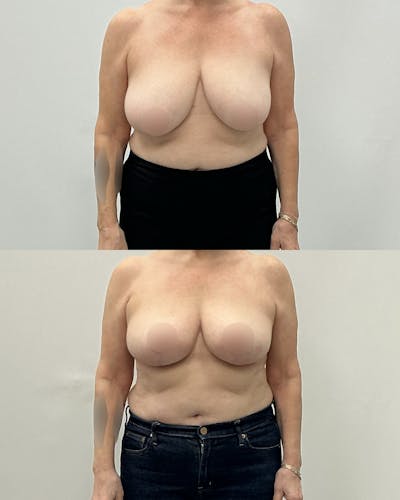 Breast Lift Before & After Gallery - Patient 384287 - Image 1