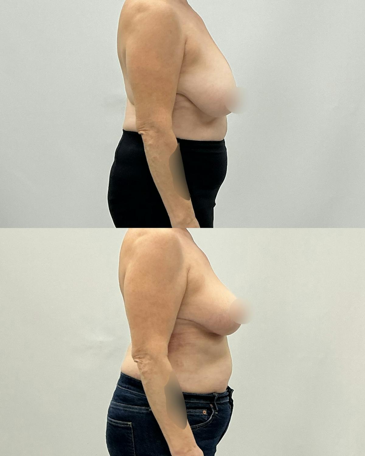 Breast Lift Before & After Gallery - Patient 384287 - Image 3