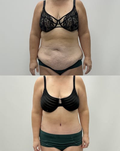 Tummy Tuck Before & After Gallery - Patient 122462 - Image 1