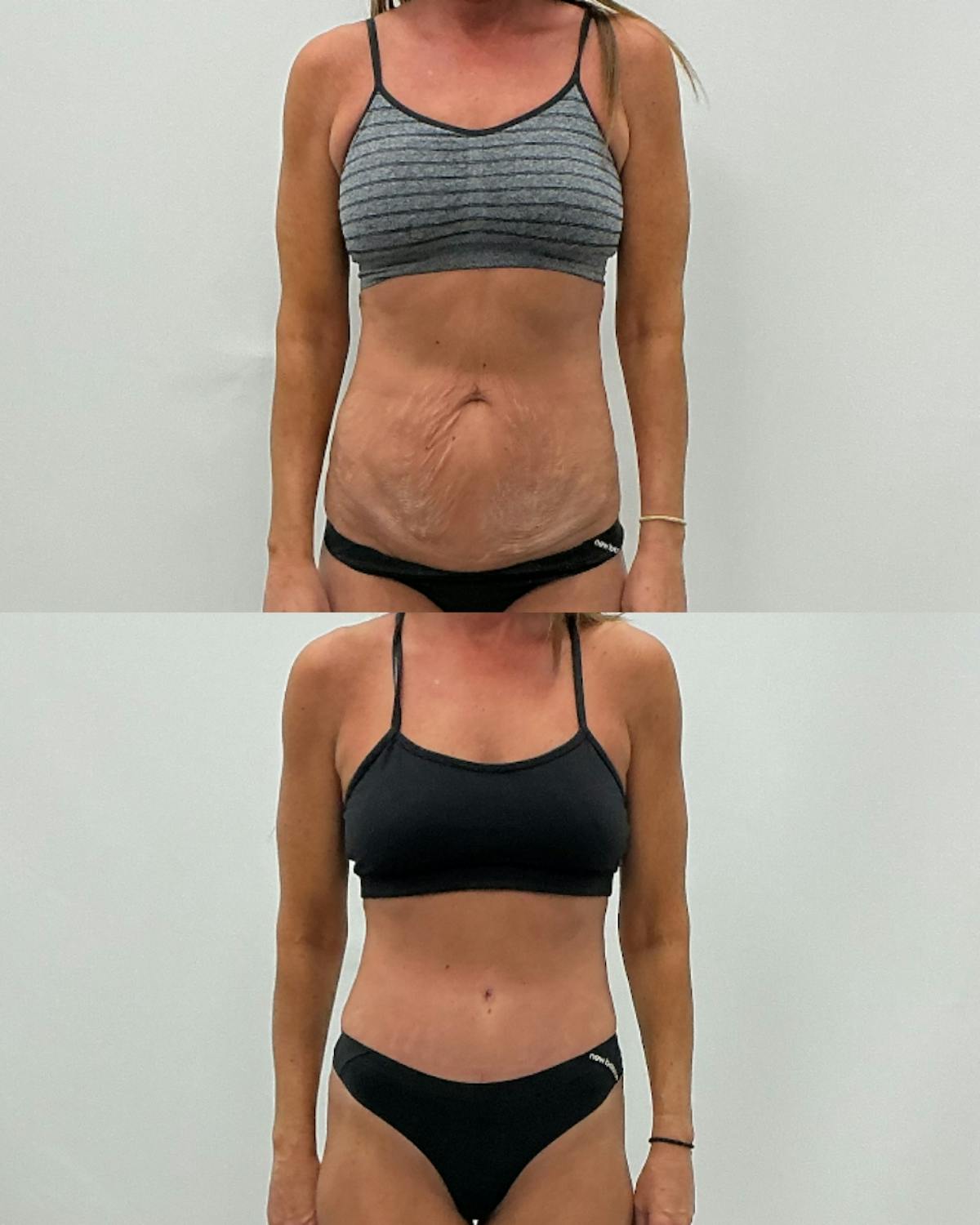 Tummy Tuck Before & After Gallery - Patient 210836 - Image 1