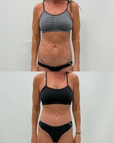 Tummy Tuck Before & After Gallery - Patient 210836 - Image 1