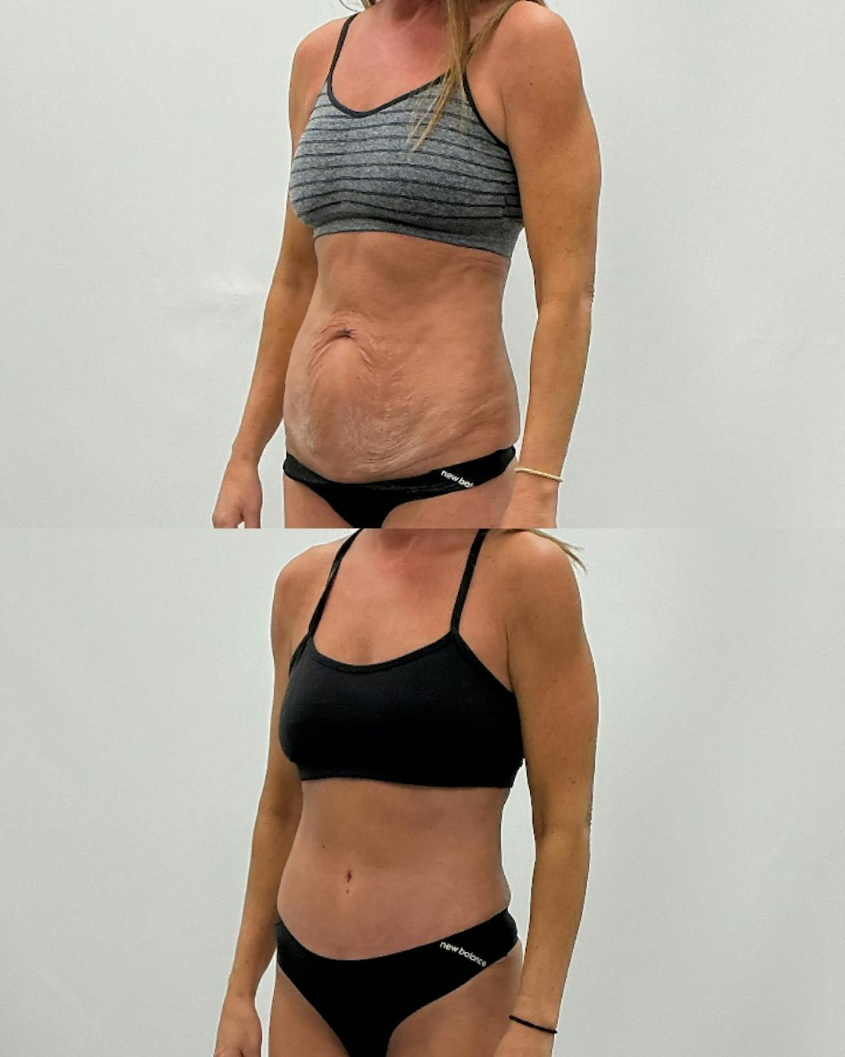 Tummy Tuck Before & After Gallery - Patient 210836 - Image 2