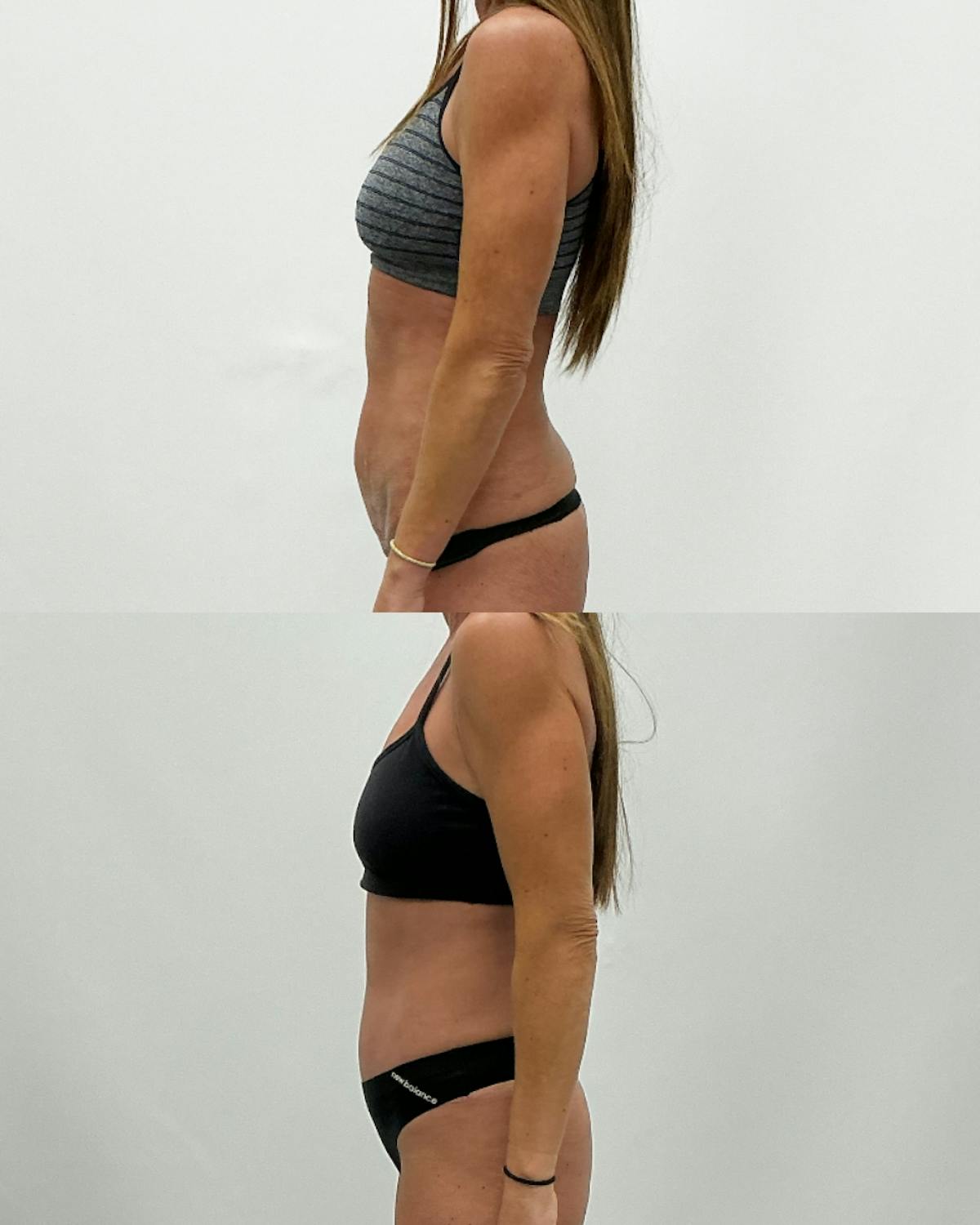 Tummy Tuck Before & After Gallery - Patient 210836 - Image 3