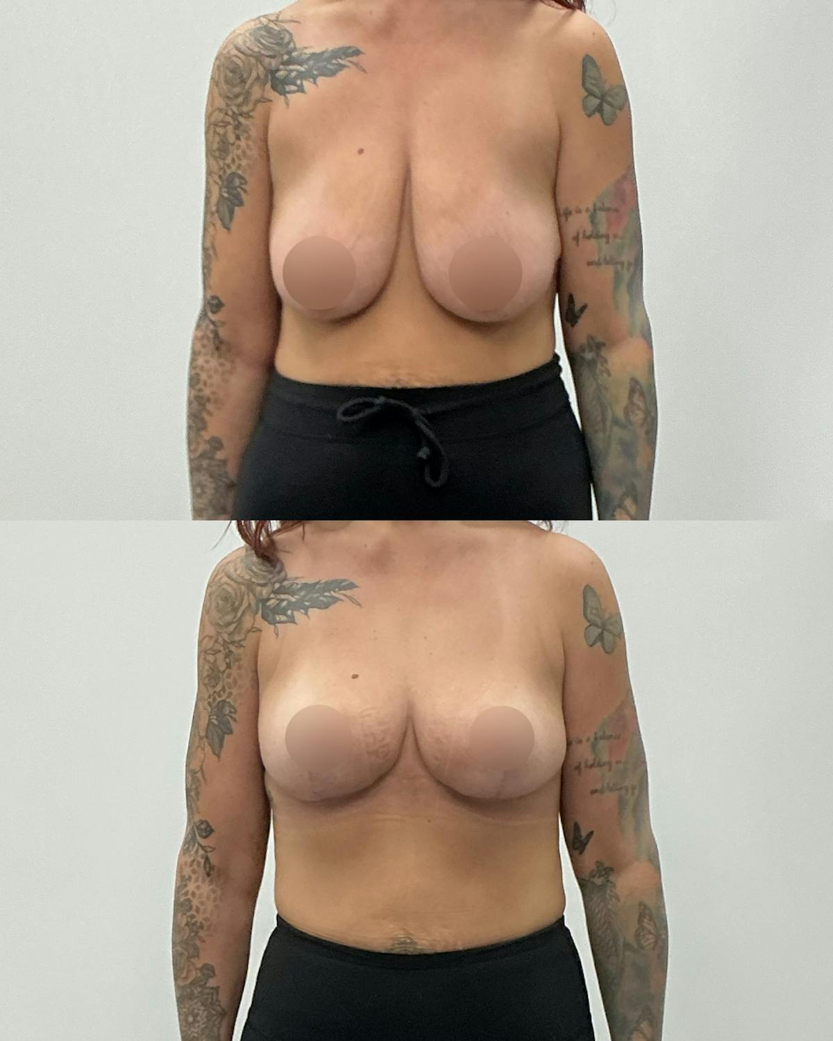 Breast Lift Before & After Gallery - Patient 393267 - Image 1