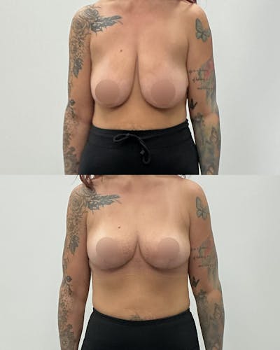 Breast Lift Before & After Gallery - Patient 393267 - Image 1