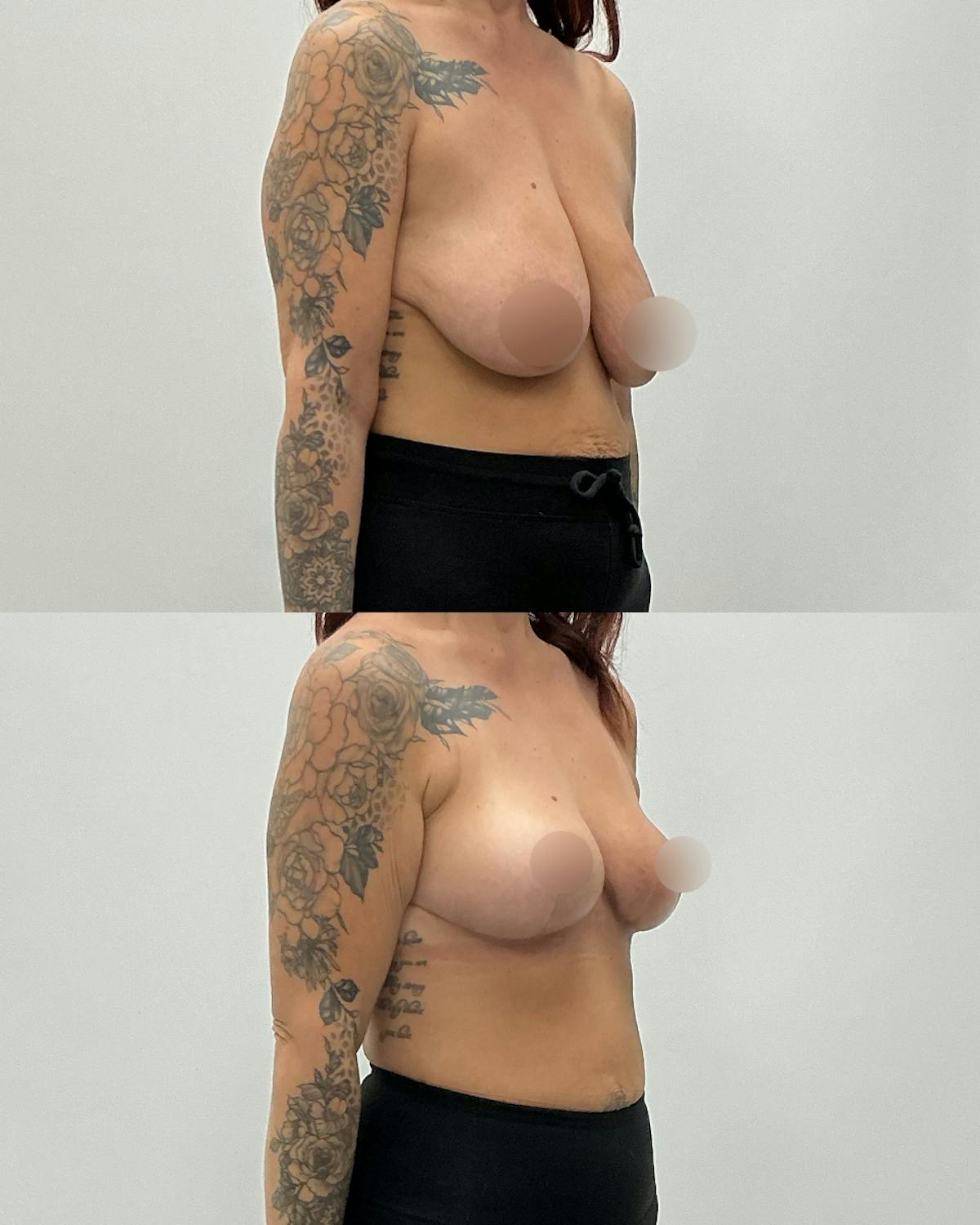 Breast Lift Before & After Gallery - Patient 393267 - Image 2