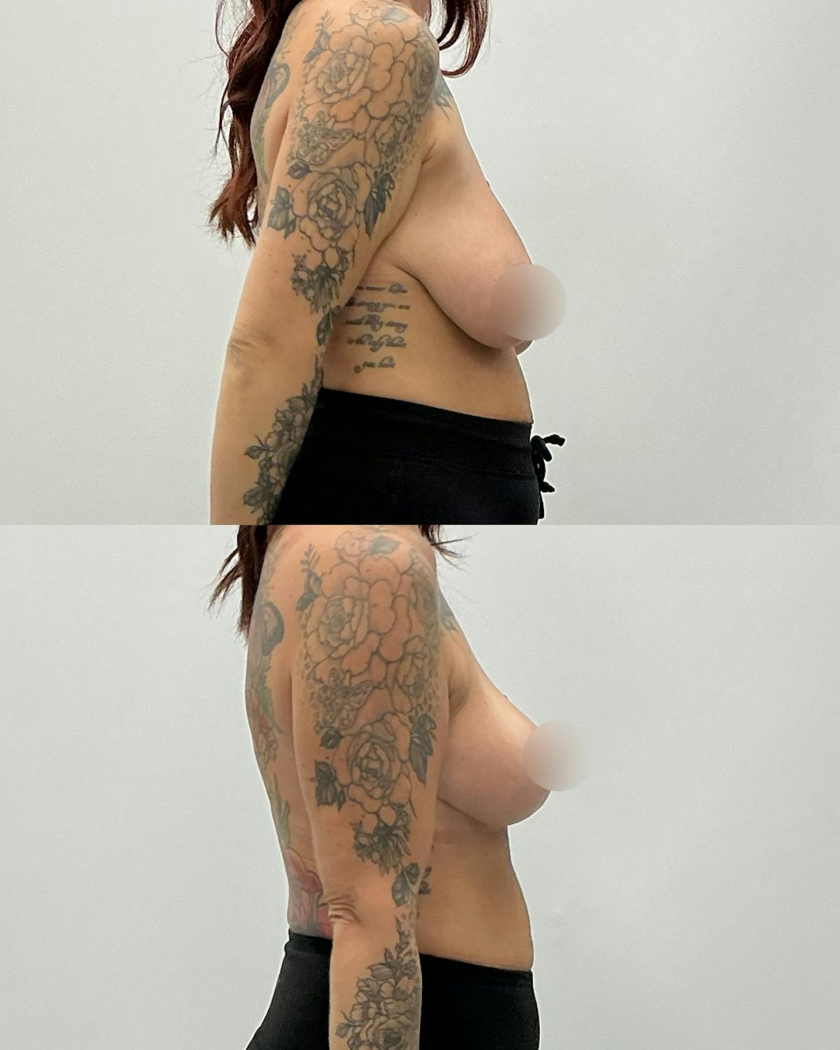 Breast Lift Before & After Gallery - Patient 393267 - Image 3