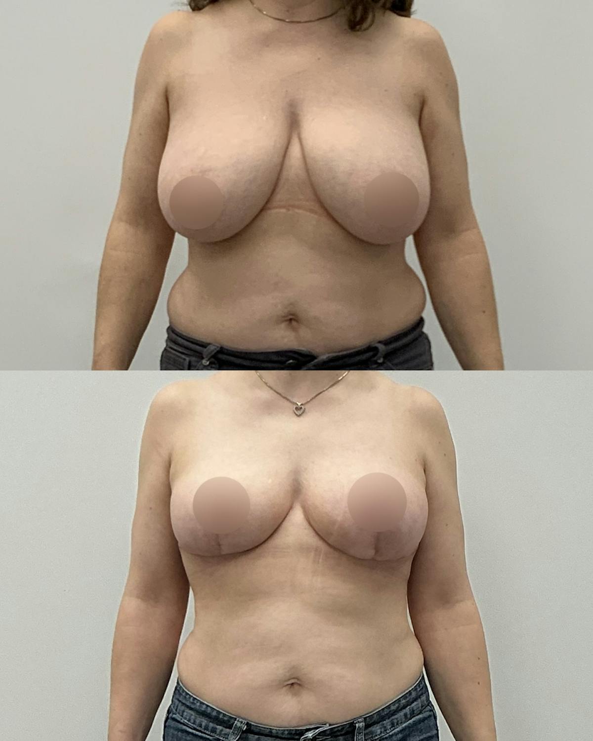 Breast Lift Before & After Gallery - Patient 394601 - Image 1