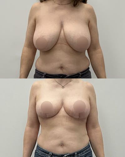 Breast Lift Before & After Gallery - Patient 394601 - Image 1