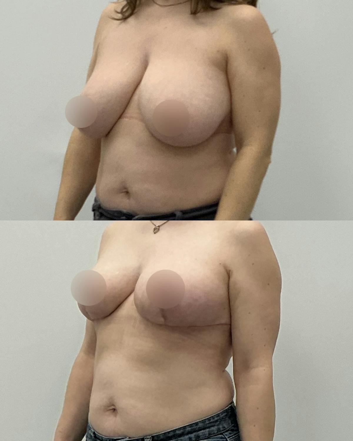 Breast Lift Before & After Gallery - Patient 394601 - Image 2