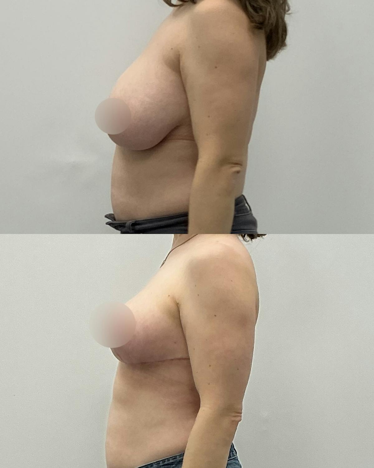 Breast Lift Before & After Gallery - Patient 394601 - Image 3